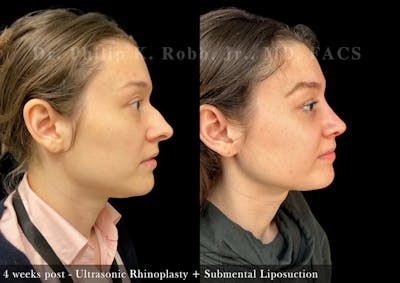 Submental Liposuction Before & After Gallery - Patient 275062 - Image 1