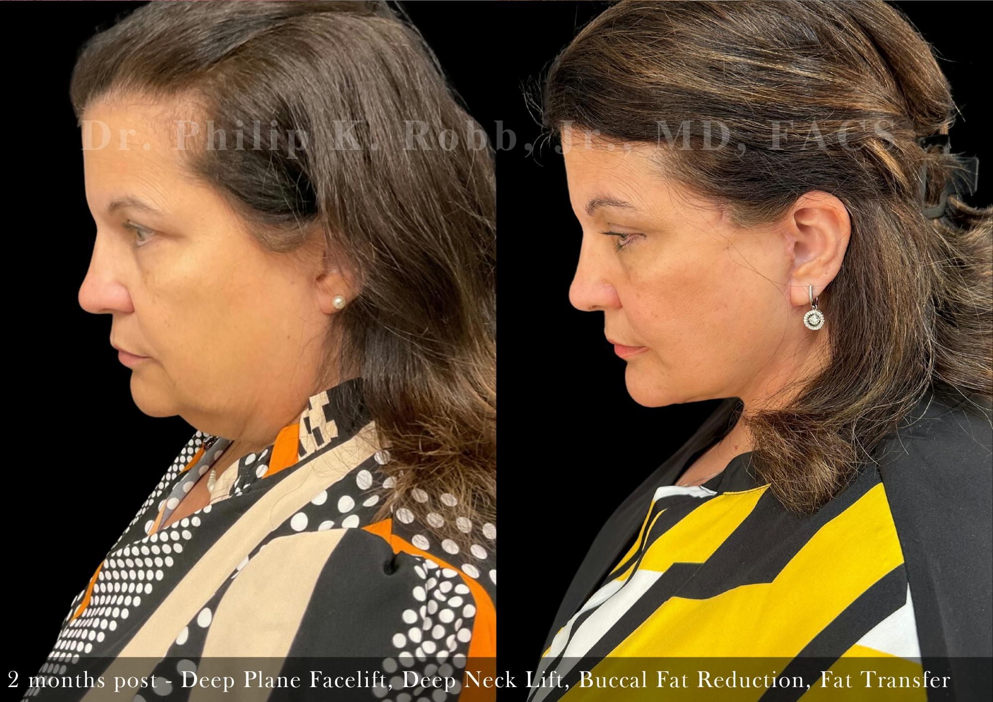 Facial Implants & Fat Transfer Before & After Gallery - Patient 338601 - Image 7