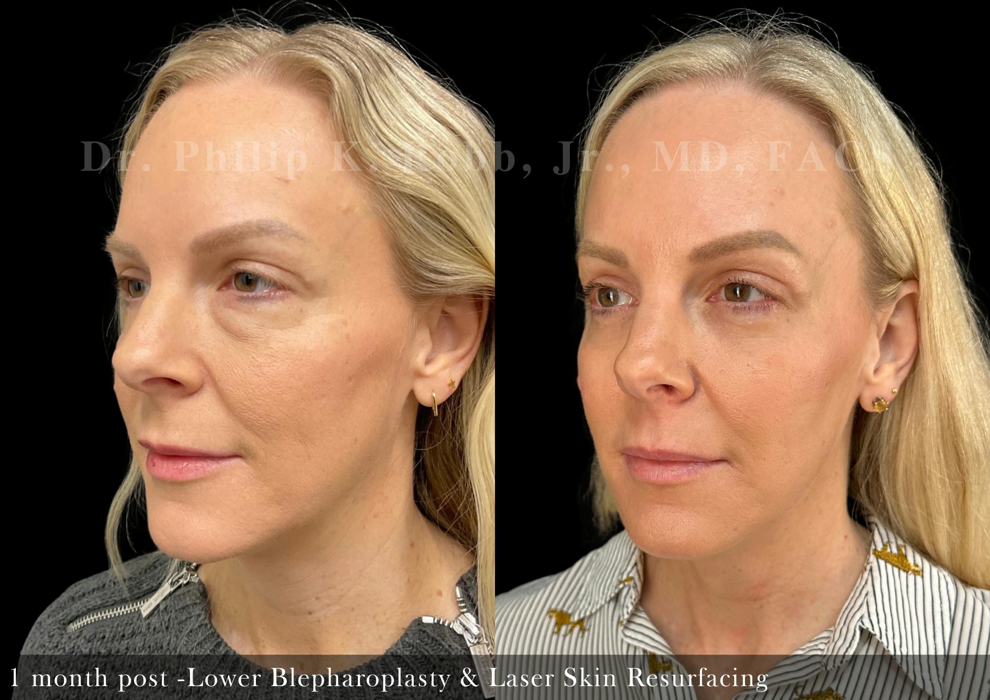 Lower Blepharoplasty Before & After Gallery - Patient 419061 - Image 2