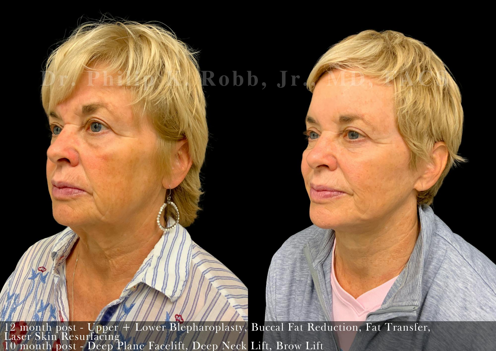 Brow Lift Before & After Gallery - Patient 598368 - Image 2