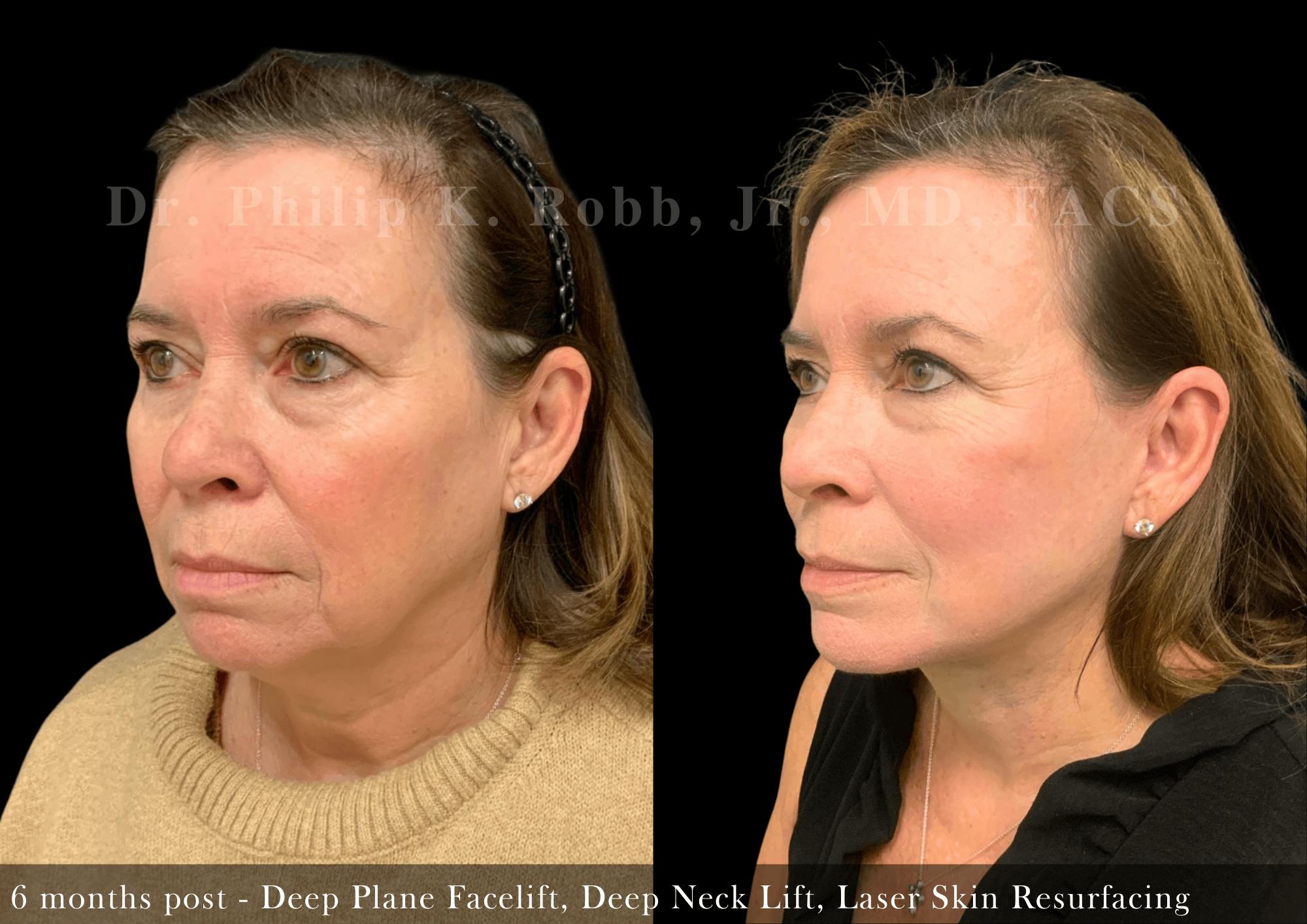 Laser Skin Resurfacing Before & After Gallery - Patient 103387 - Image 2