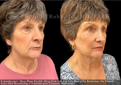 Facial Implants & Fat Transfer Before & After Gallery - Patient 396545 - Image 1
