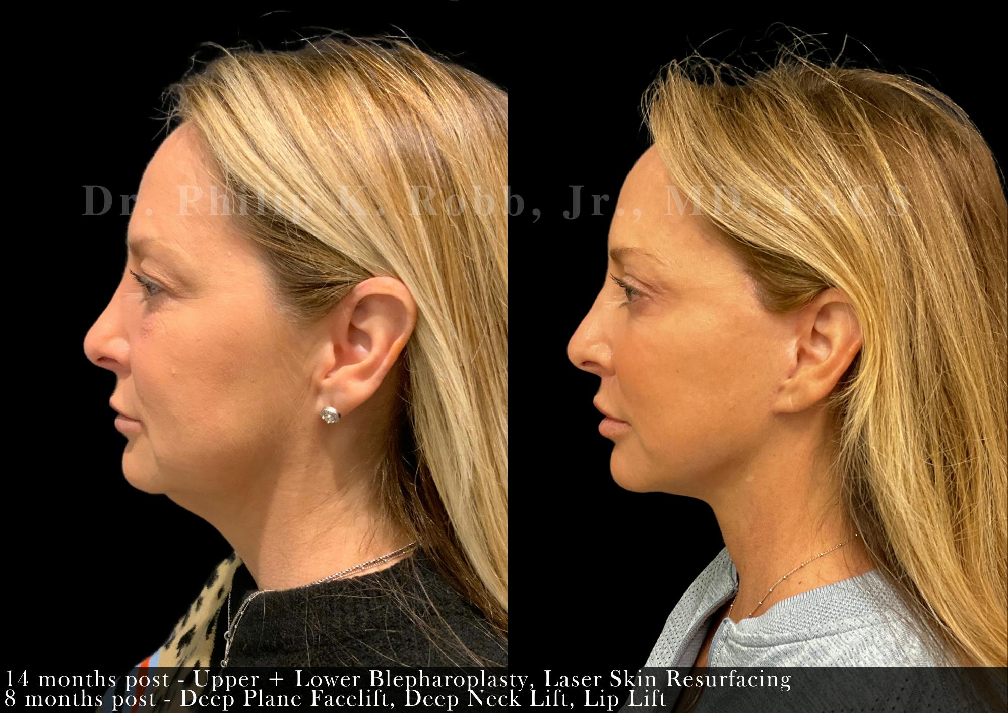 Facelift Before & After Gallery - Patient 242809 - Image 2