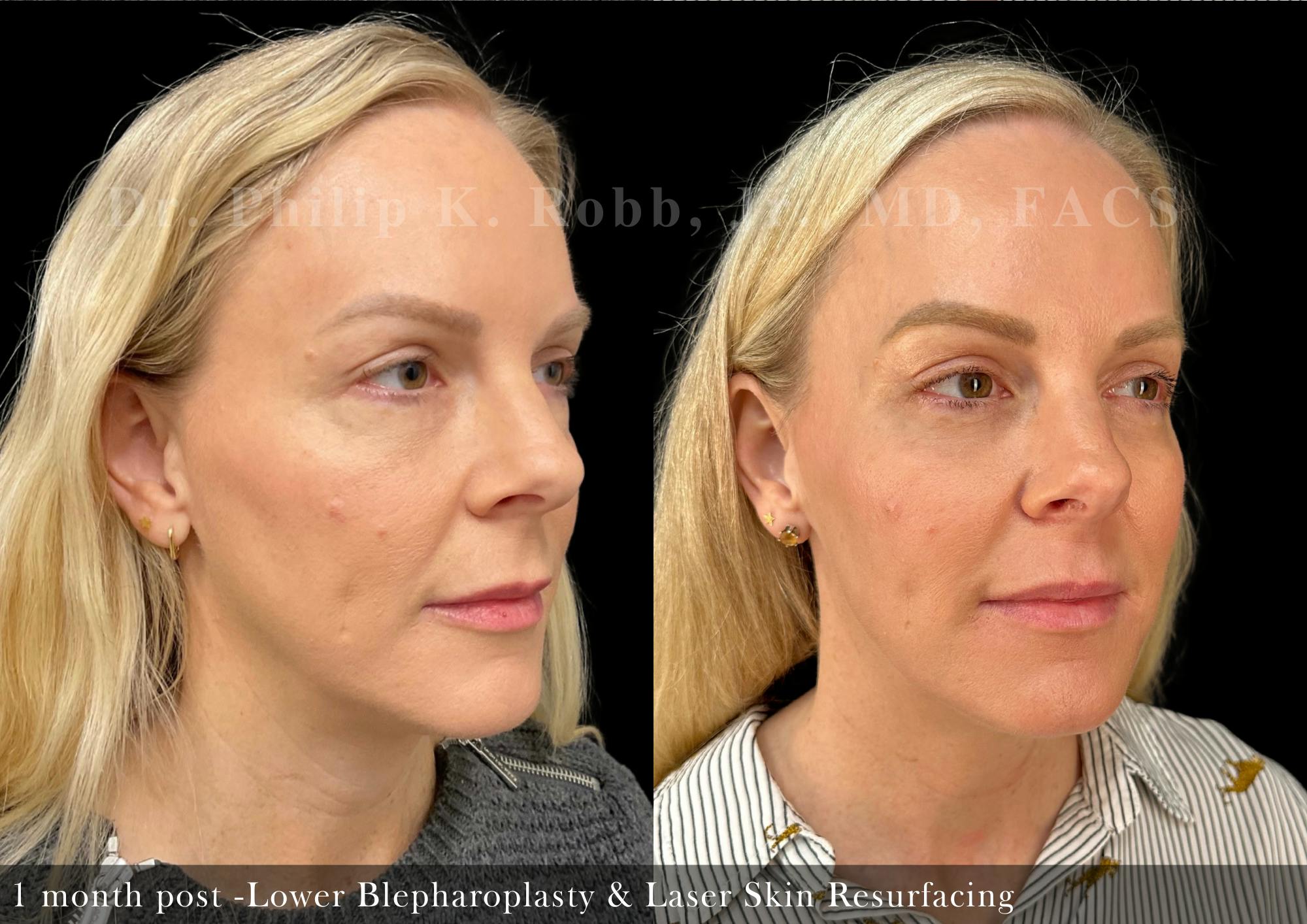 Lower Blepharoplasty Before & After Gallery - Patient 419061 - Image 3