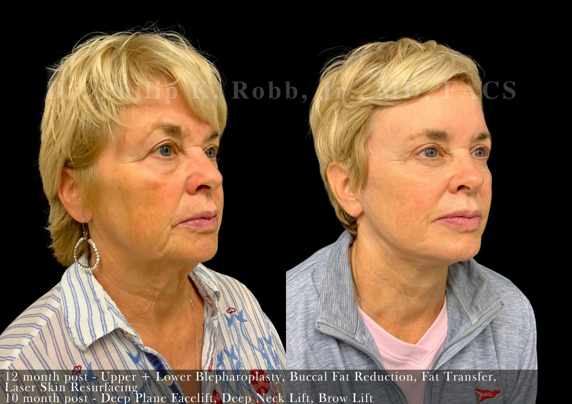 Brow Lift Before & After Gallery - Patient 598368 - Image 4