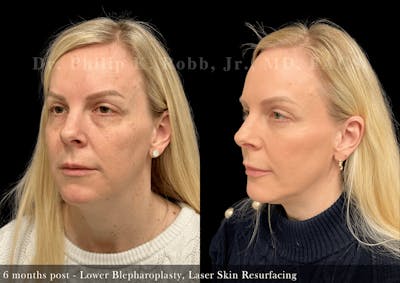 Laser Skin Resurfacing Before & After Gallery - Patient 173028 - Image 1