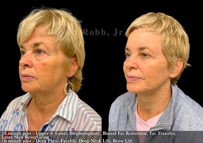 Facelift Before & After Gallery - Patient 349446 - Image 1