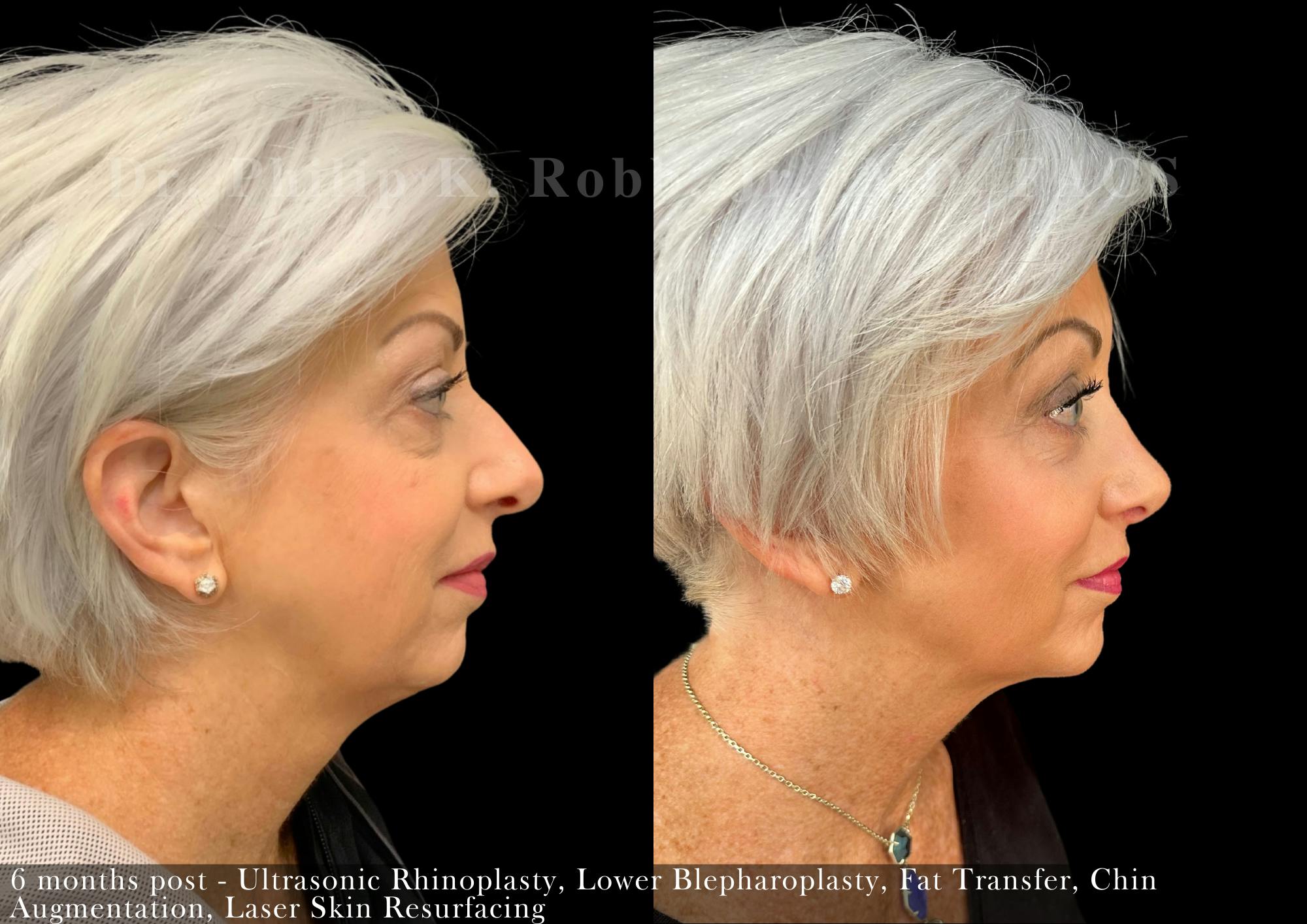 Fat Transfer Before & After Gallery - Patient 353180 - Image 3