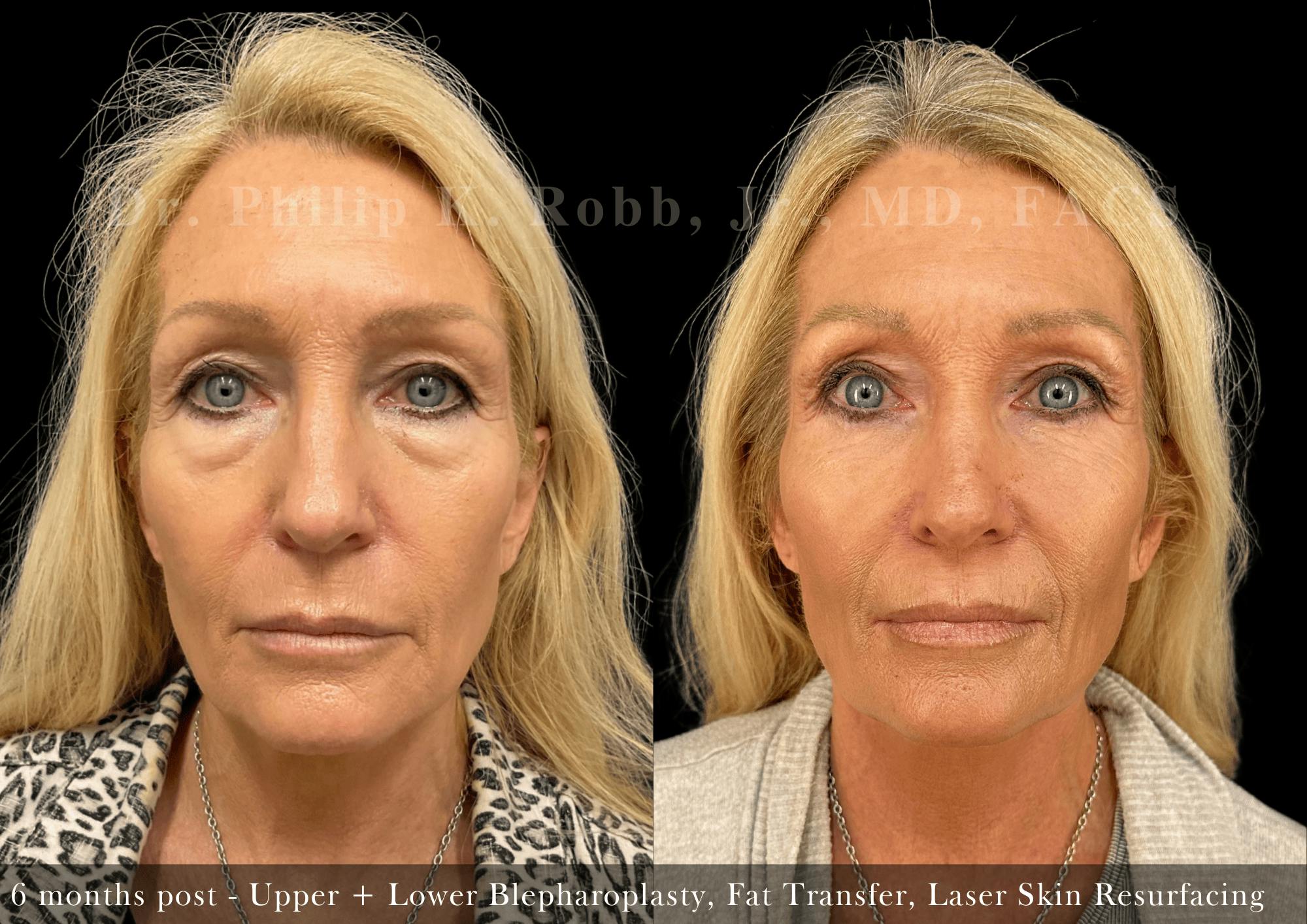 Upper Blepharoplasty Before & After Gallery - Patient 188381 - Image 1