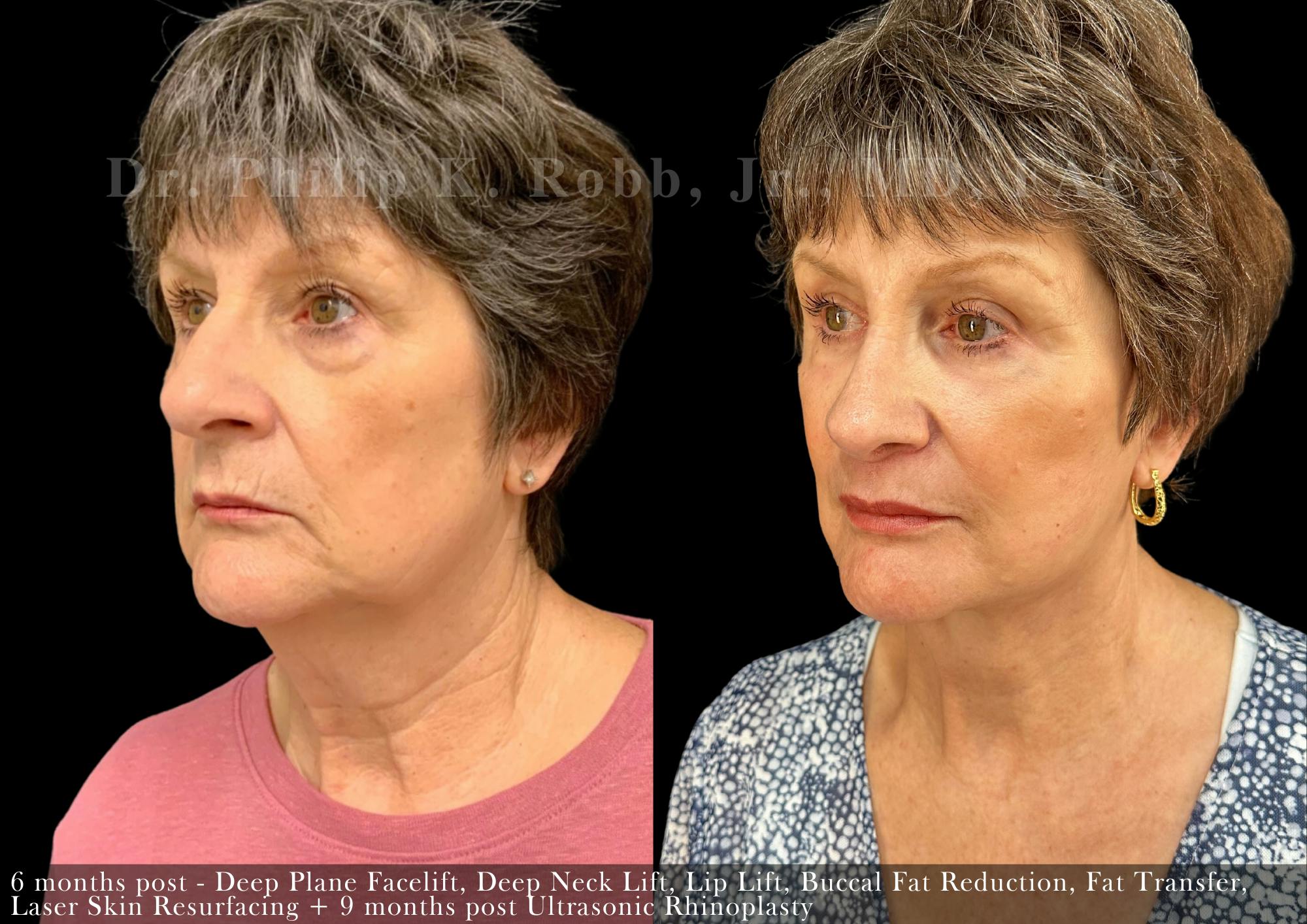 Facial Implants & Fat Transfer Before & After Gallery - Patient 396545 - Image 3