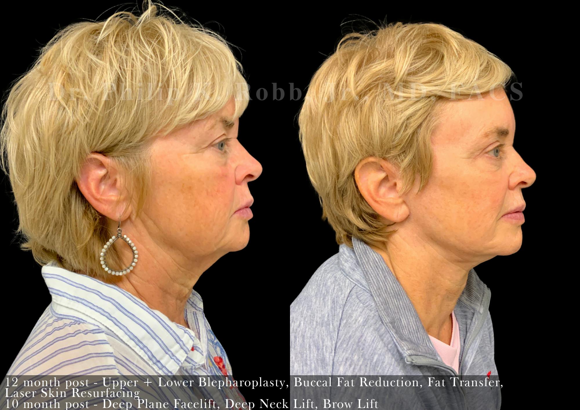 Brow Lift Before & After Gallery - Patient 598368 - Image 5