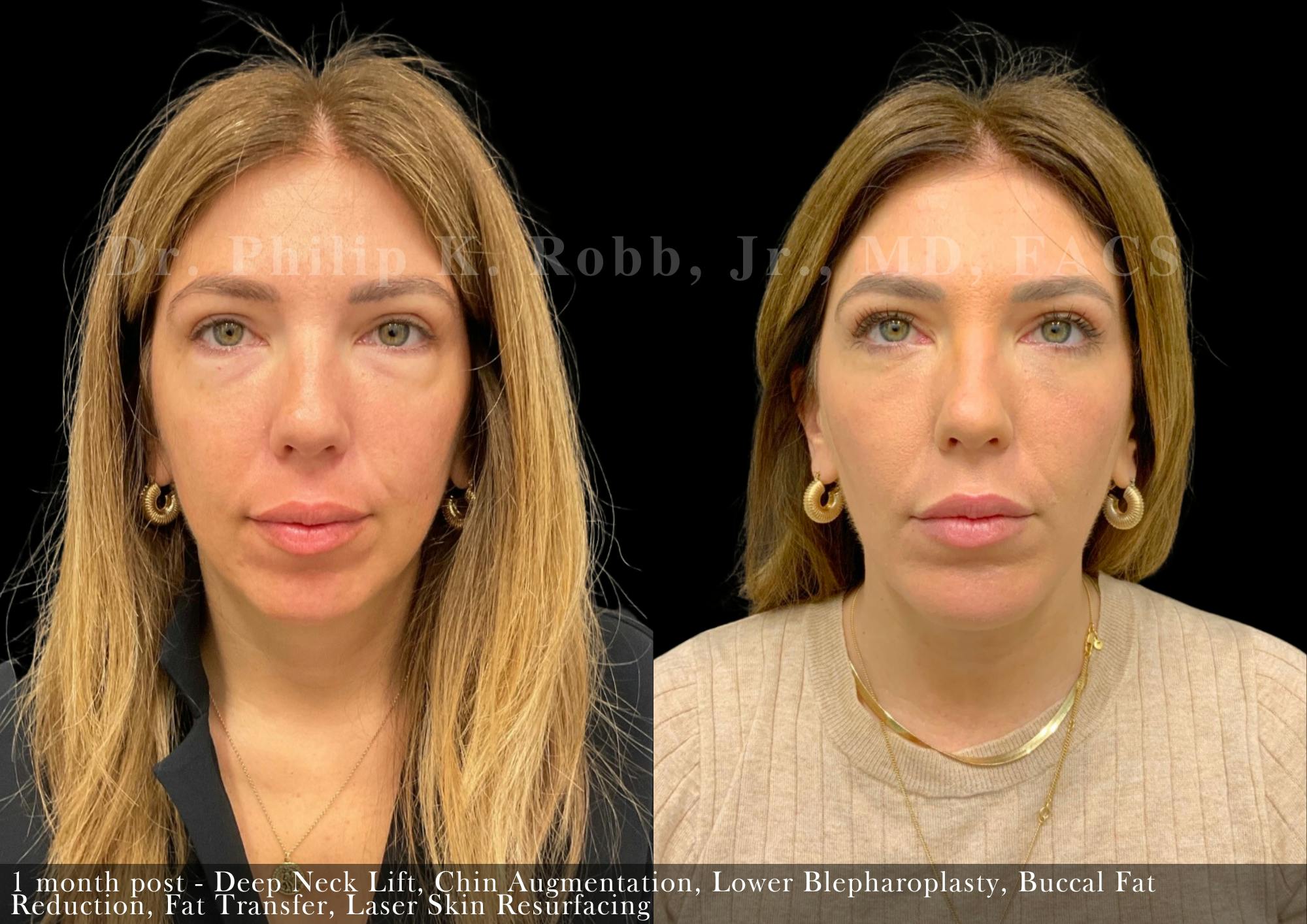 Chin Augmentation Before & After Gallery - Patient 368301 - Image 3