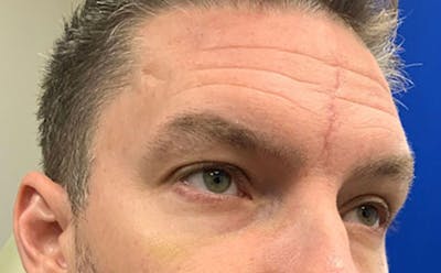 Scar Revision Before & After Gallery - Patient 427141 - Image 1