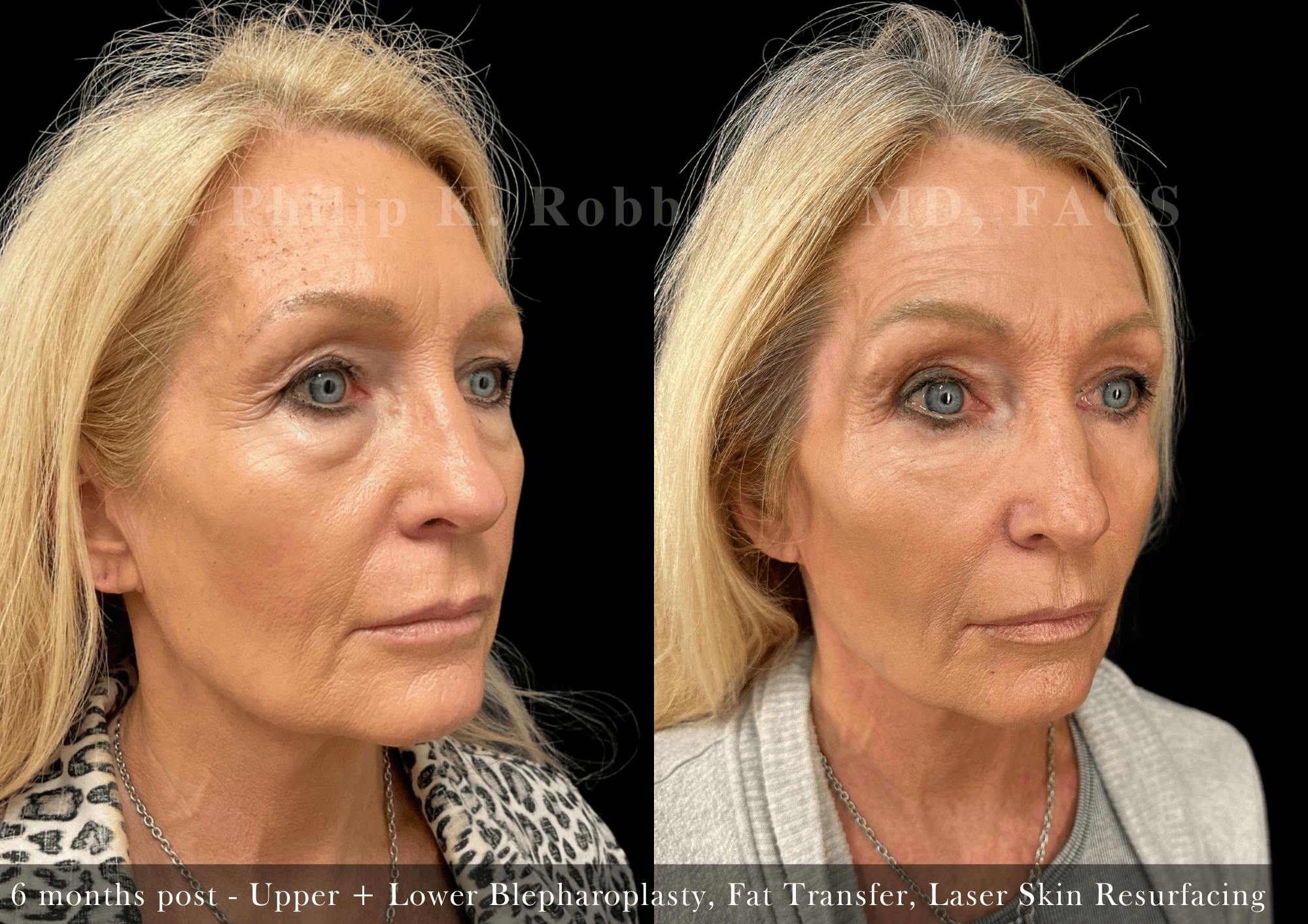 Upper Blepharoplasty Before & After Gallery - Patient 188381 - Image 3