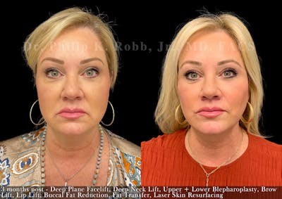Brow Lift Before & After Gallery - Patient 258526 - Image 1