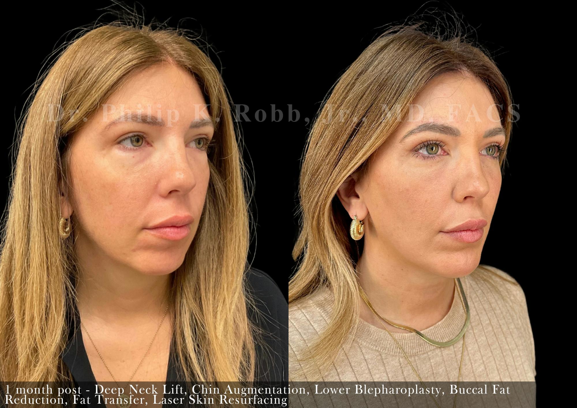Chin Augmentation Before & After Gallery - Patient 368301 - Image 4