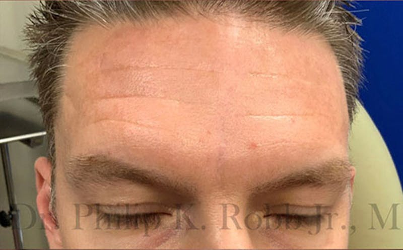 Scar Revision Before & After Gallery - Patient 427141 - Image 2