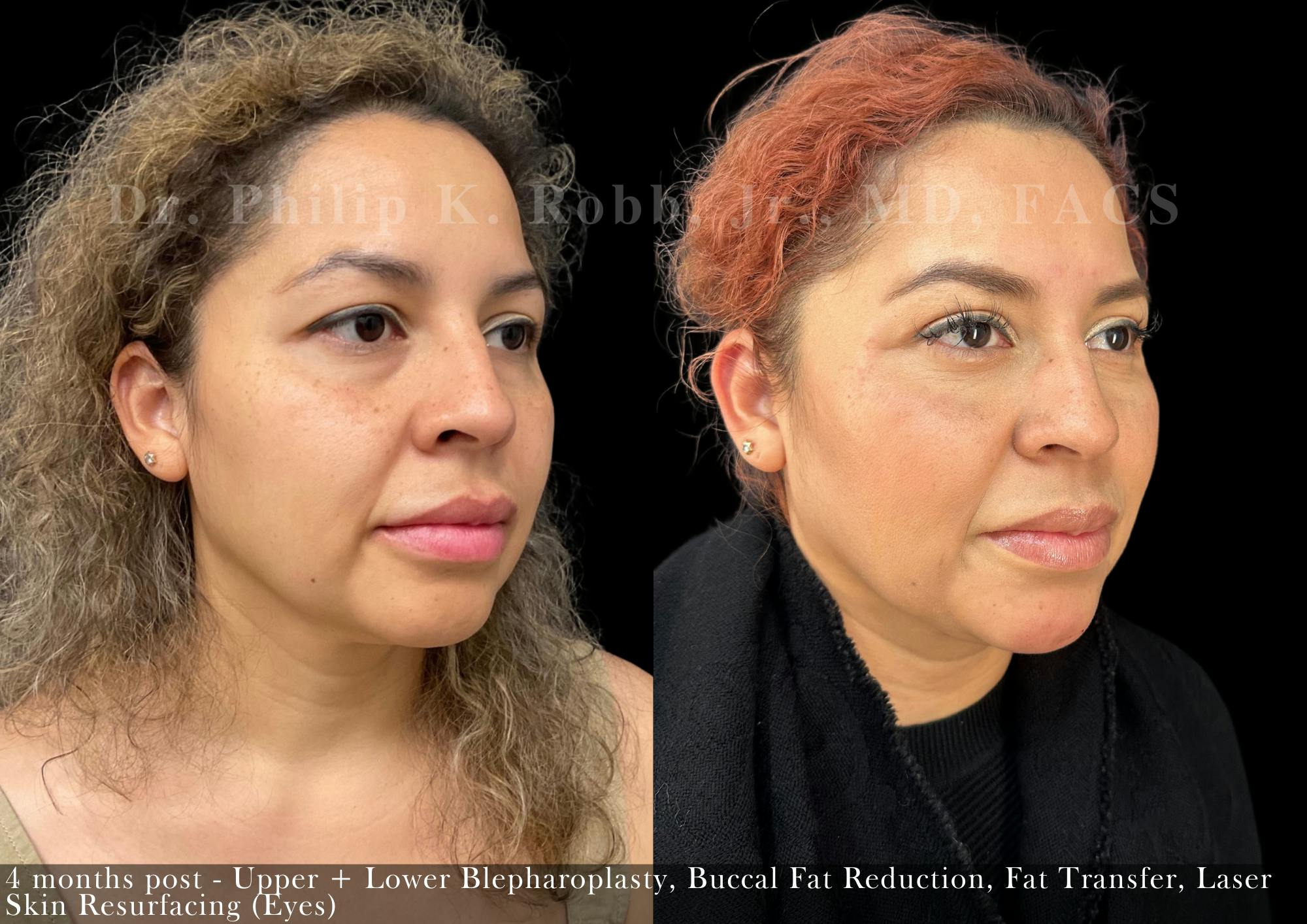 Buccal Fat Reduction Before & After Gallery - Patient 427614 - Image 2