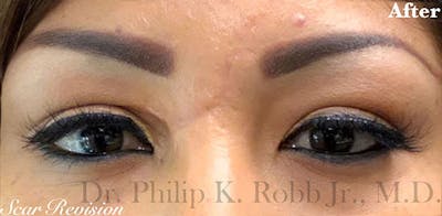 Scar Revision Before & After Gallery - Patient 340864 - Image 2