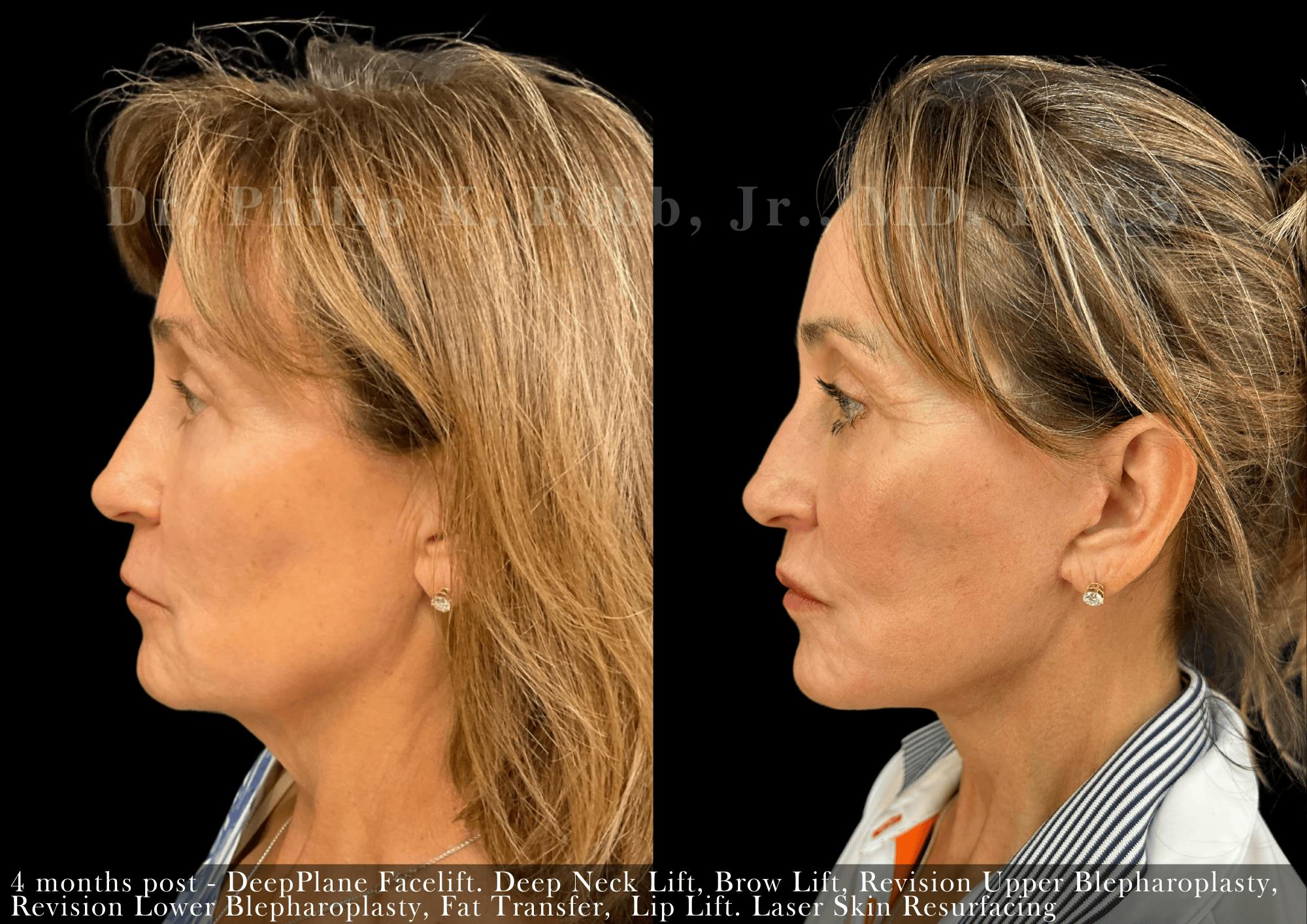 Laser Skin Resurfacing Before & After Gallery - Patient 115119 - Image 2