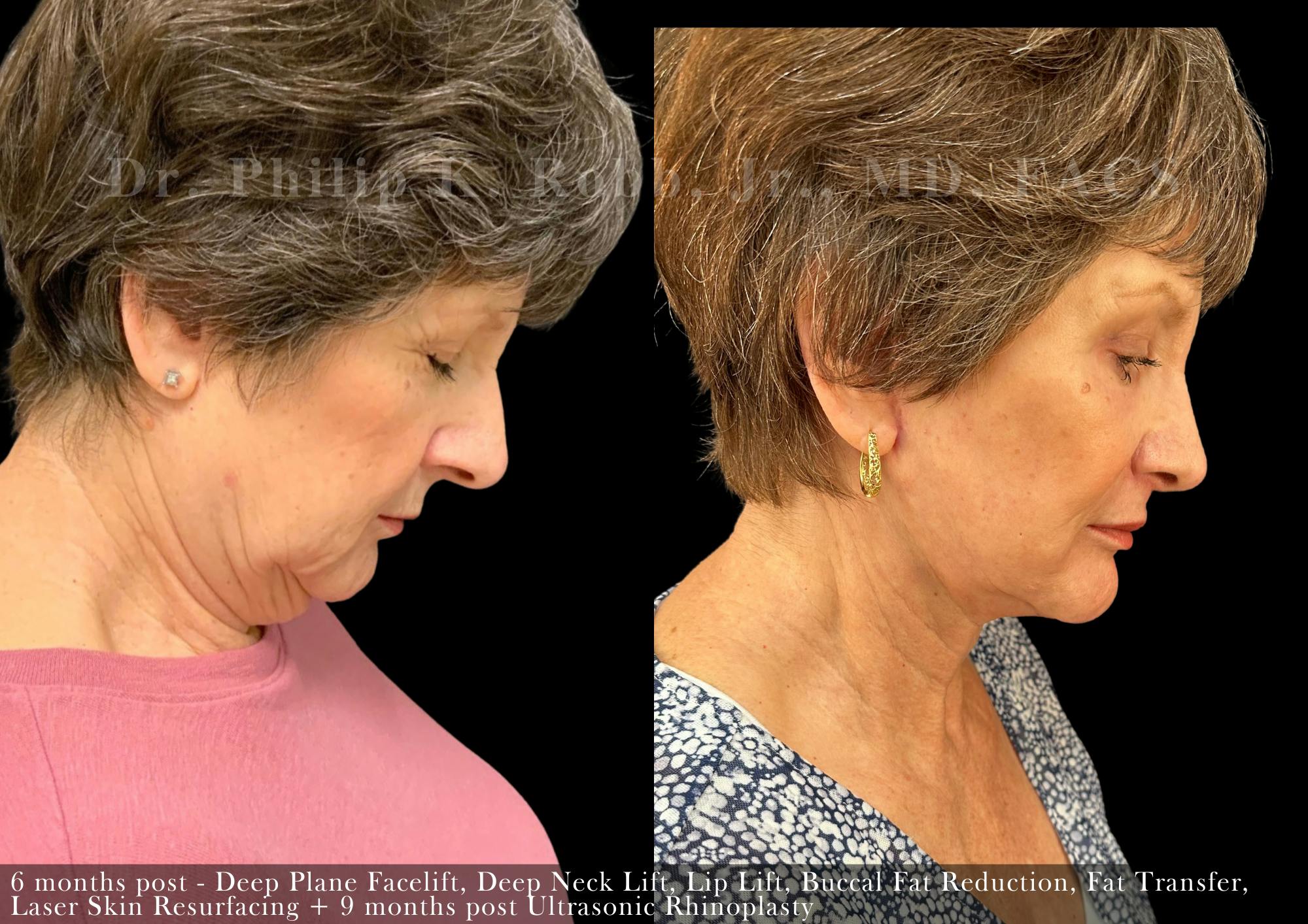 Facial Implants & Fat Transfer Before & After Gallery - Patient 396545 - Image 6