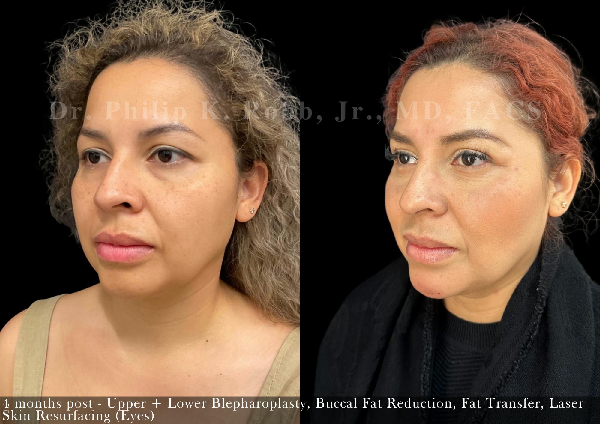 Fat Transfer Before & After Gallery - Patient 161341 - Image 3