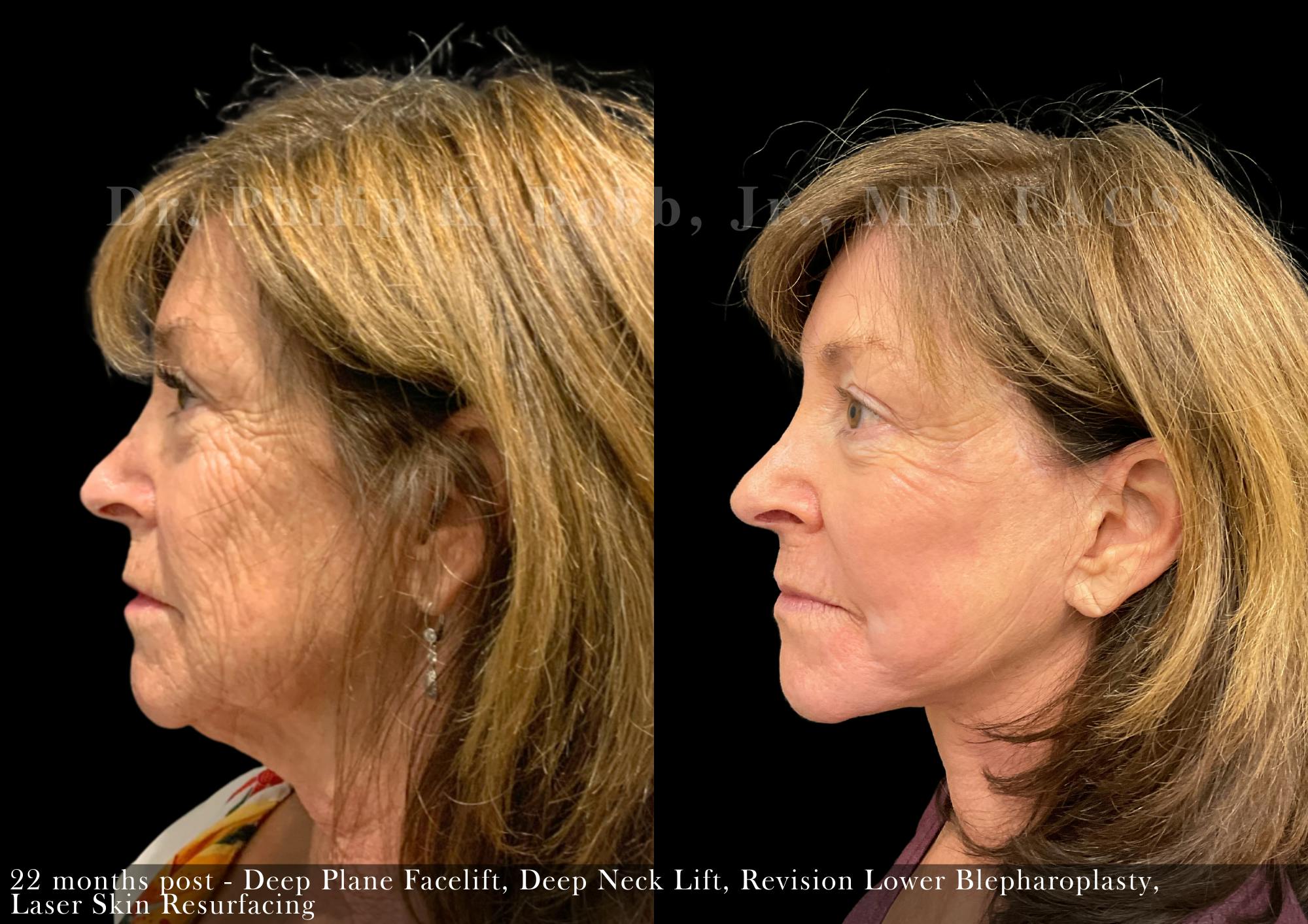 Lower Blepharoplasty Before and After Gallery