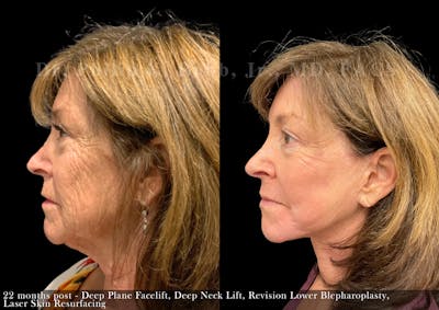 Lower Blepharoplasty Before & After Gallery - Patient 118748 - Image 1