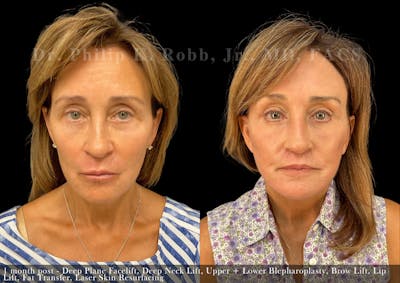Facial Implants & Fat Transfer Before & After Gallery - Patient 284452 - Image 1