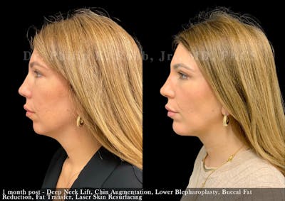 Chin Augmentation Before & After Gallery - Patient 368301 - Image 1