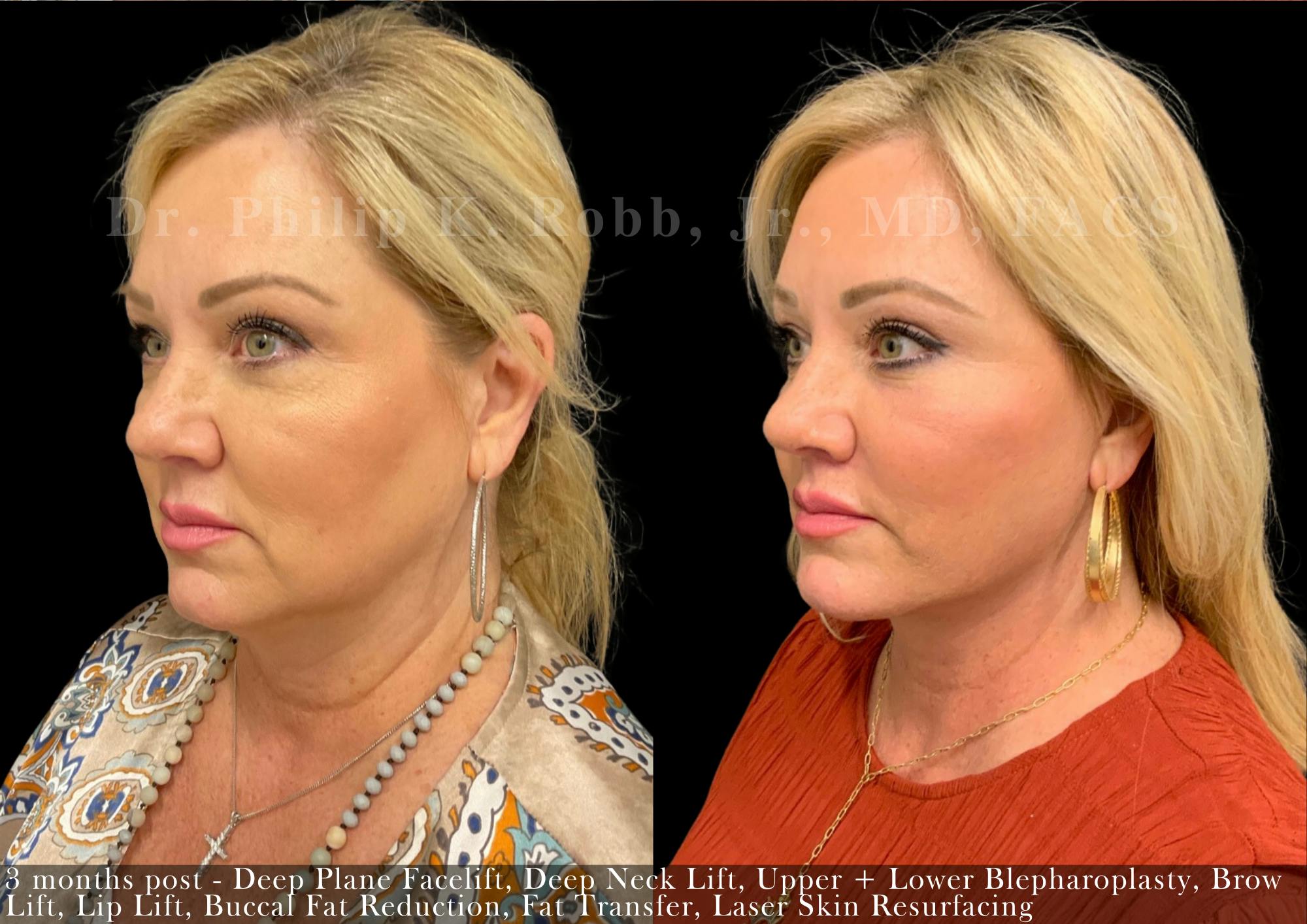 Brow Lift Before & After Gallery - Patient 258526 - Image 4