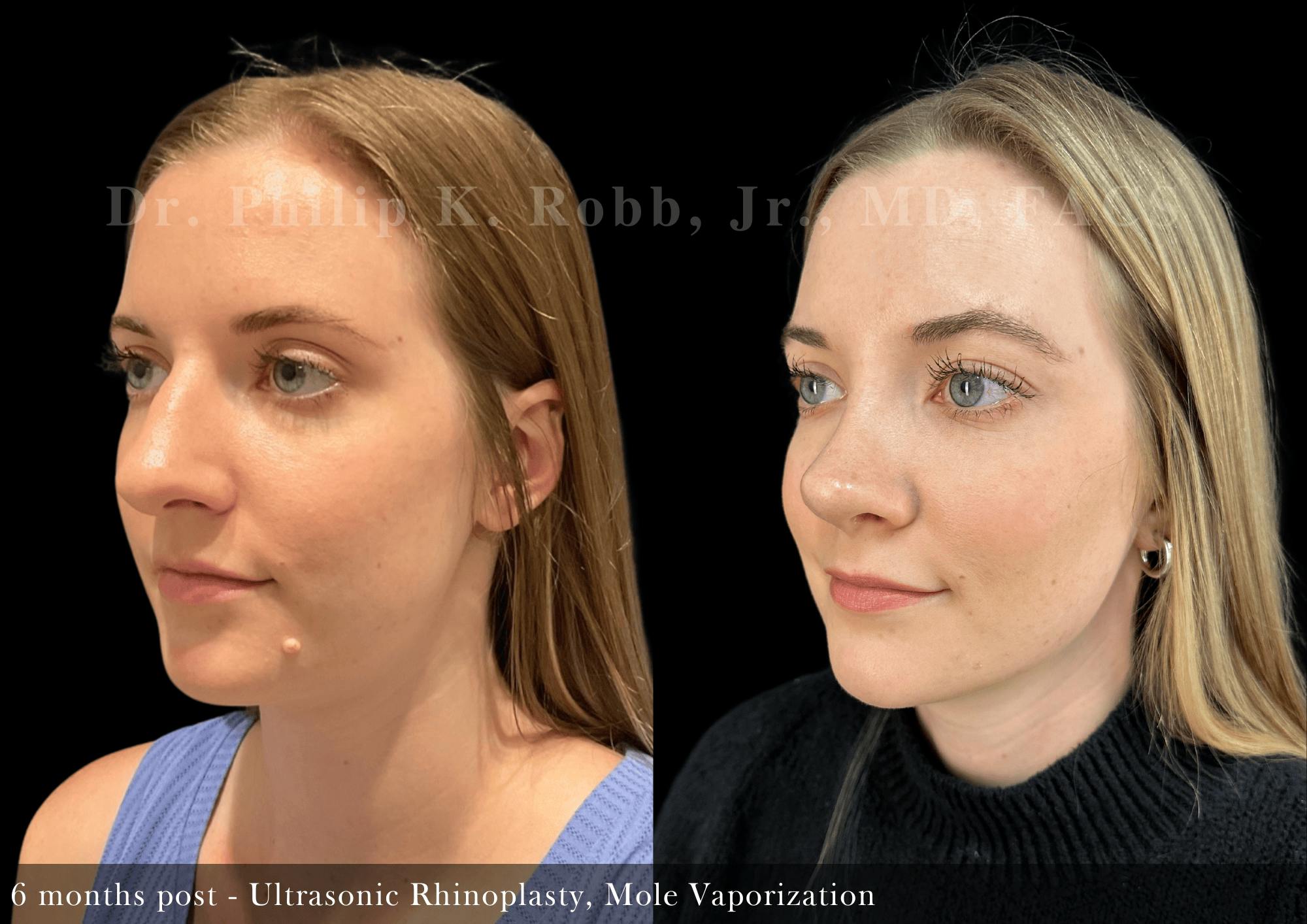 Mole Vaporization Before & After Gallery - Patient 295618 - Image 3