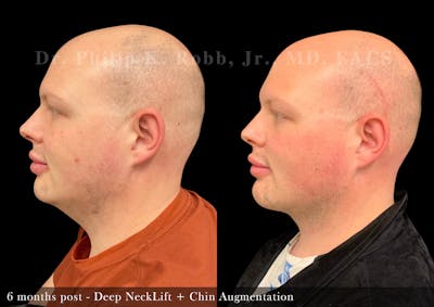 Chin Augmentation Before & After Gallery - Patient 101198 - Image 1