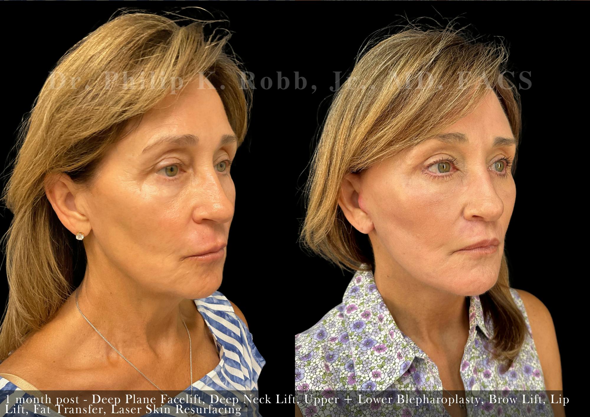 Facial Implants & Fat Transfer Before & After Gallery - Patient 284452 - Image 2