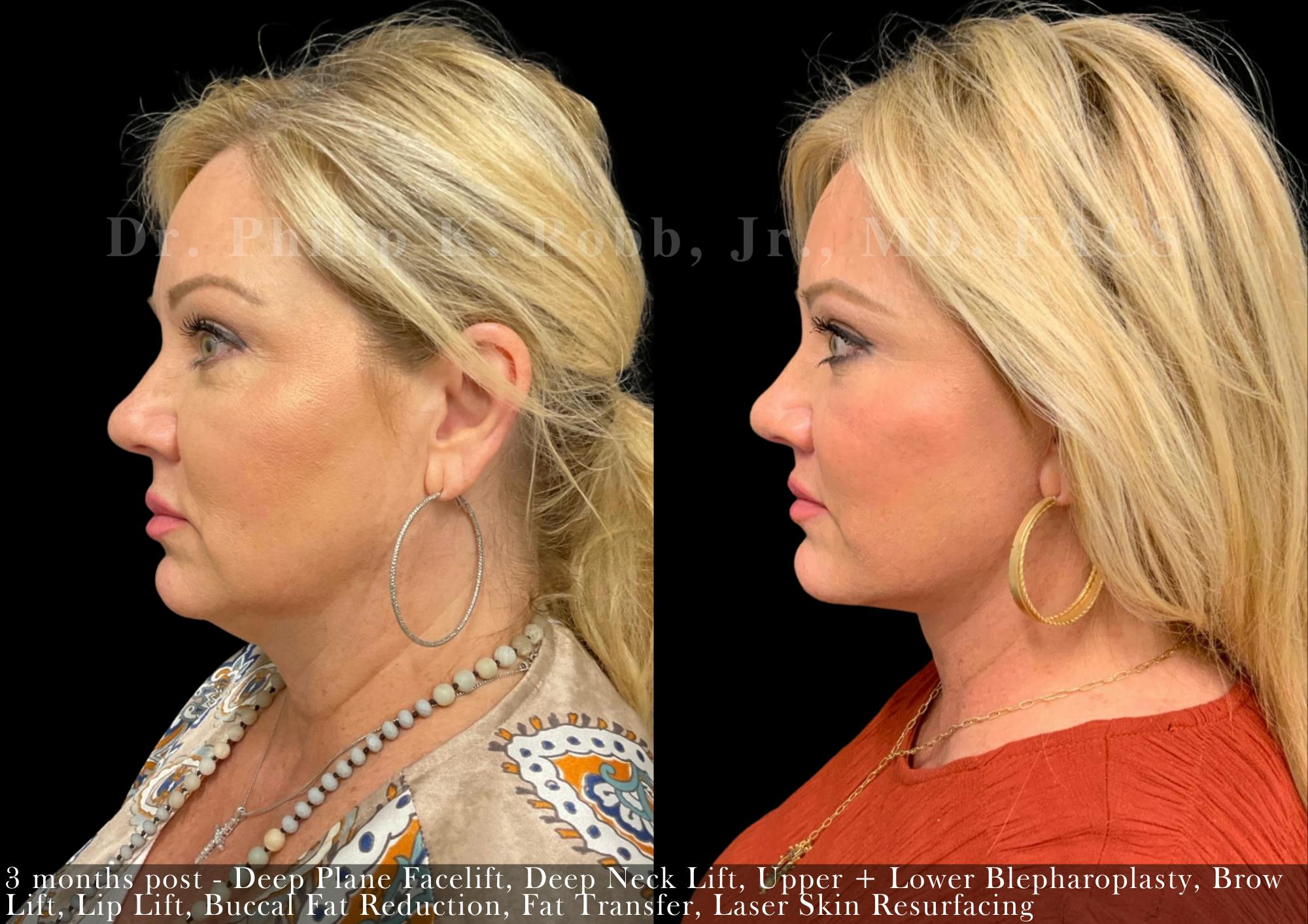 Brow Lift Before & After Gallery - Patient 258526 - Image 3