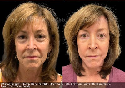 Lower Blepharoplasty Before & After Gallery - Patient 118748 - Image 1