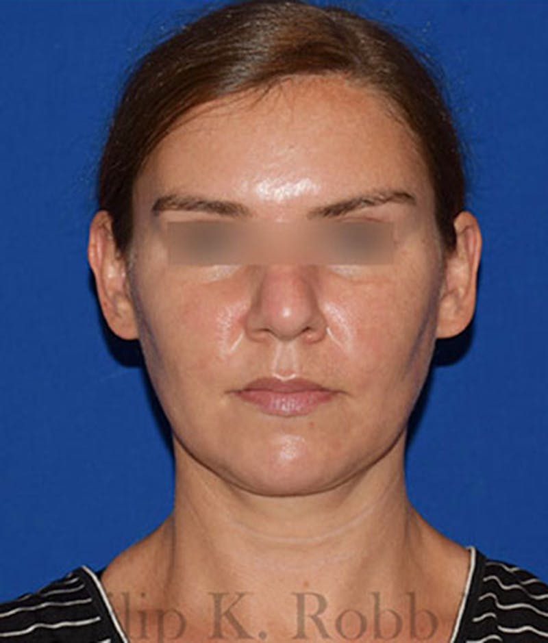 Submental Liposuction Before & After Gallery - Patient 310523 - Image 2