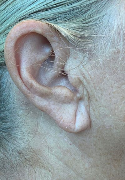 Ear Lobe Repair Before & After Gallery - Patient 142006 - Image 1