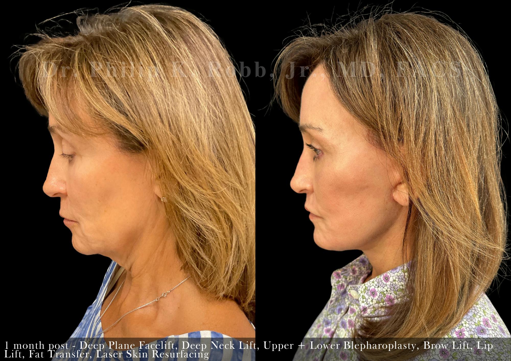 Facial Implants & Fat Transfer Before & After Gallery - Patient 284452 - Image 4