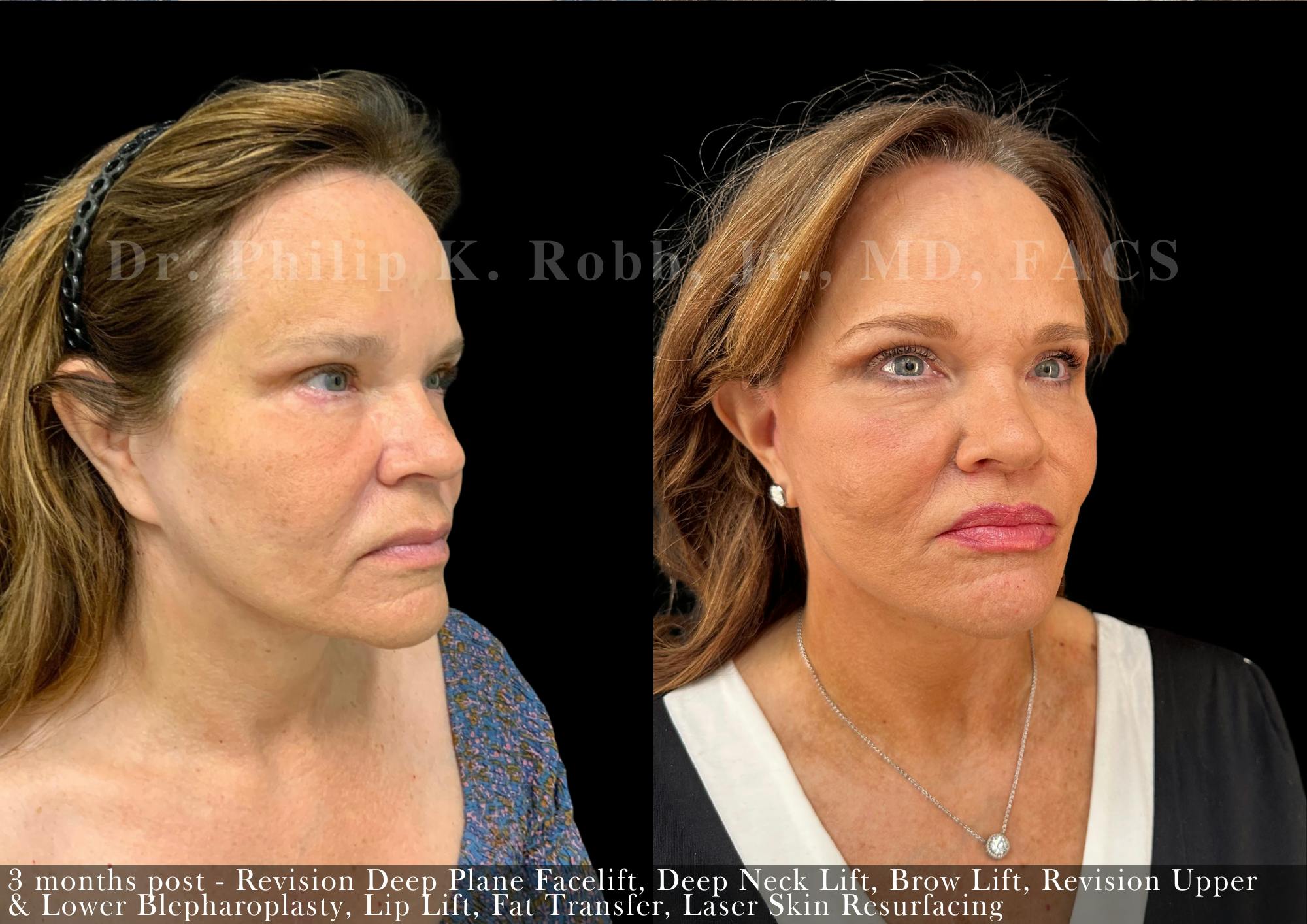 Brow Lift Before & After Gallery - Patient 427304 - Image 5