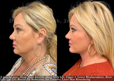 Neck Lift Before & After Gallery - Patient 816983 - Image 1