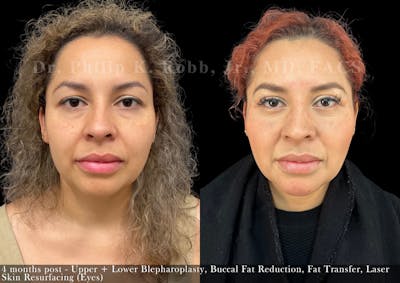 Upper Blepharoplasty Before & After Gallery - Patient 100598 - Image 1