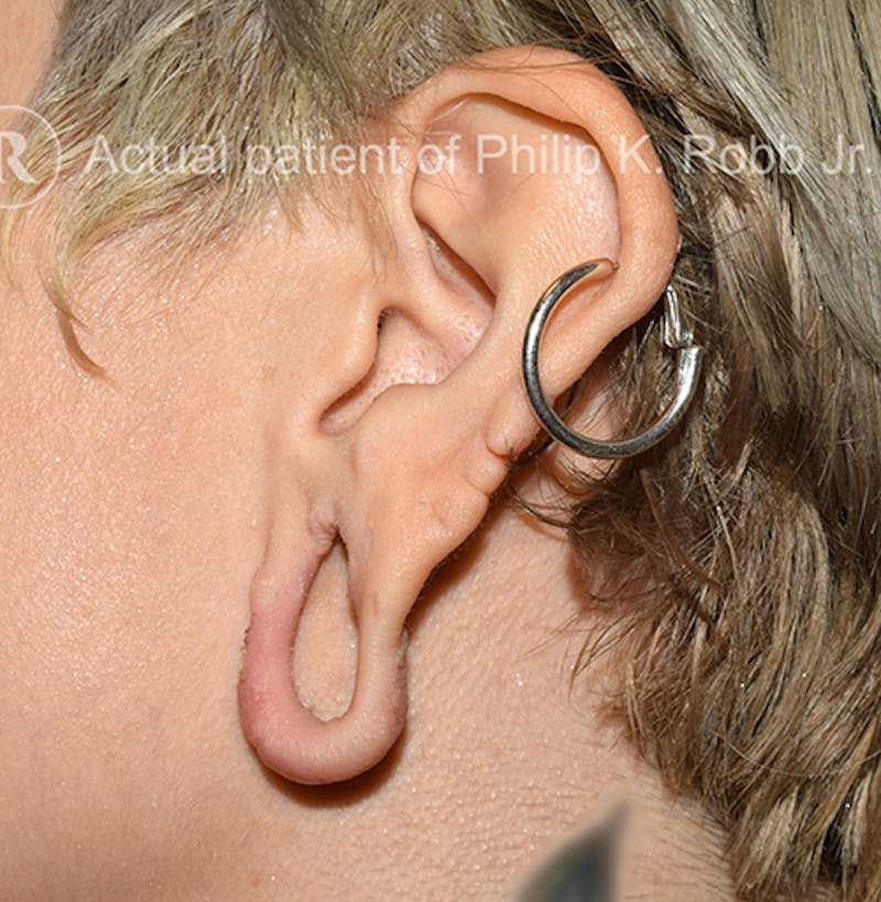 Ear Lobe Repair Before & After Gallery - Patient 542309 - Image 1