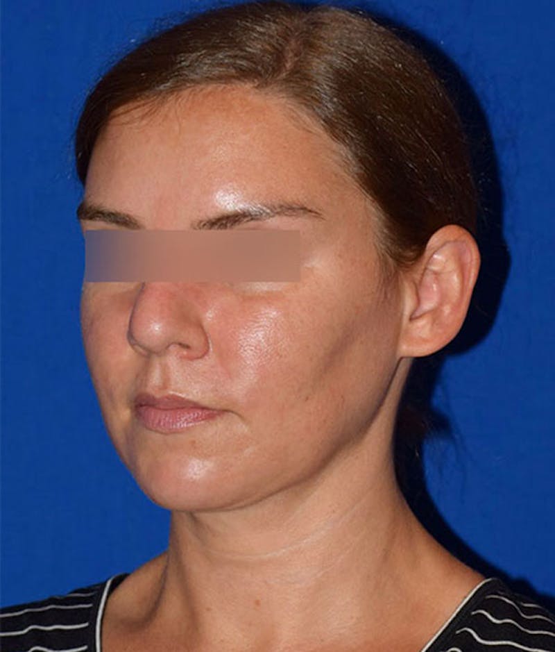 Submental Liposuction Before & After Gallery - Patient 310523 - Image 4