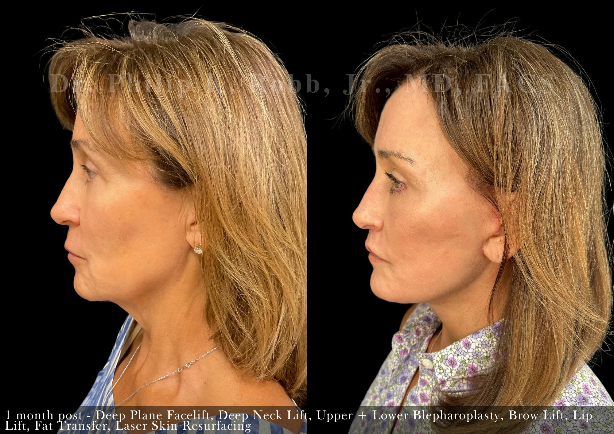 Facial Implants & Fat Transfer Before & After Gallery - Patient 284452 - Image 5