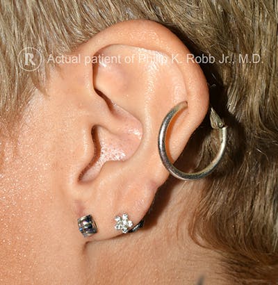 Ear Lobe Repair Before & After Gallery - Patient 542309 - Image 2