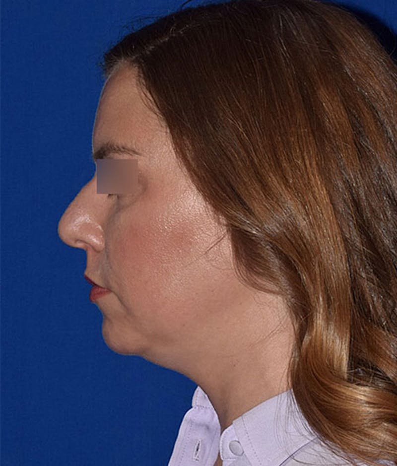Submental Liposuction Before & After Gallery - Patient 310523 - Image 5