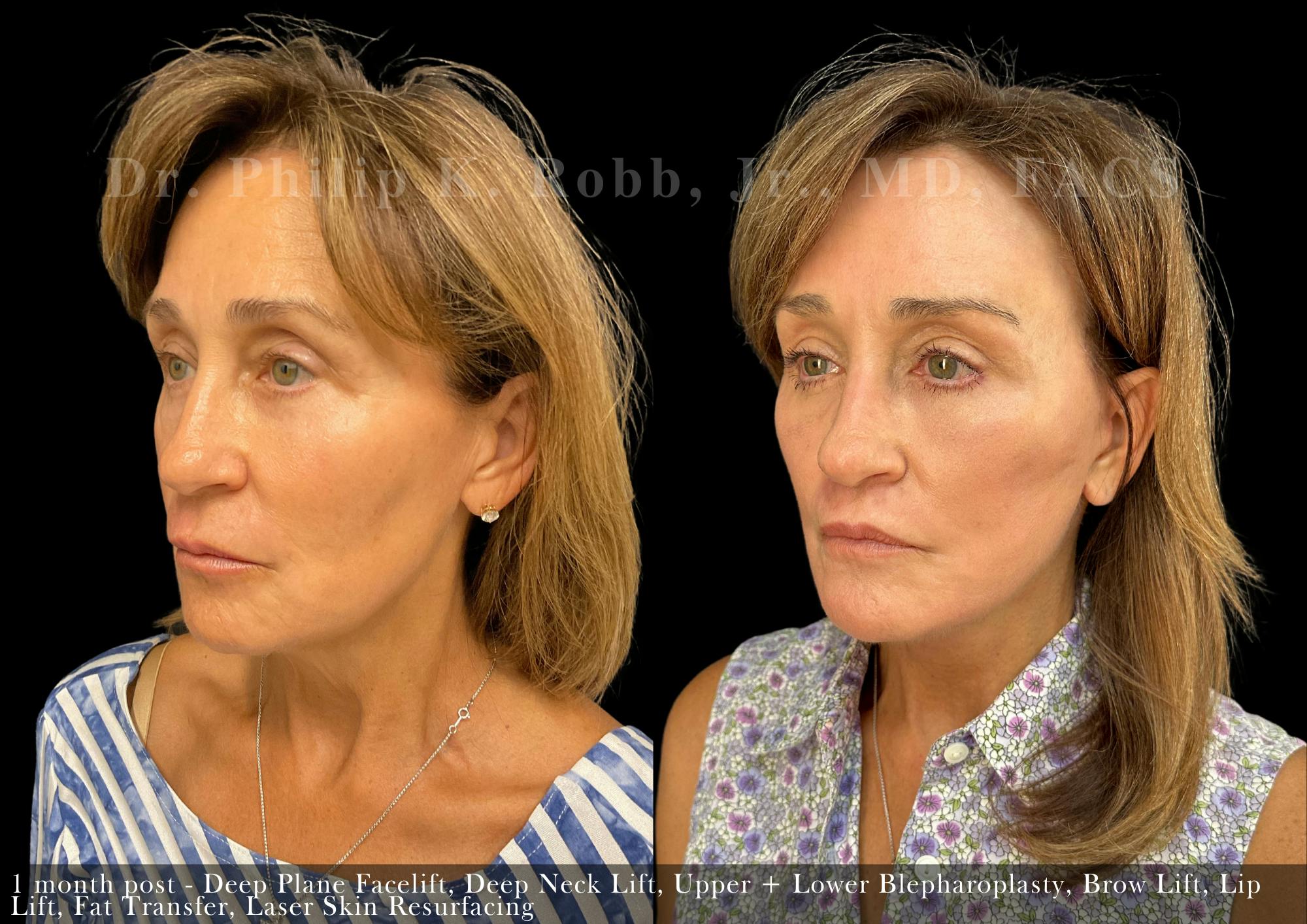 Facial Implants & Fat Transfer Before & After Gallery - Patient 284452 - Image 6