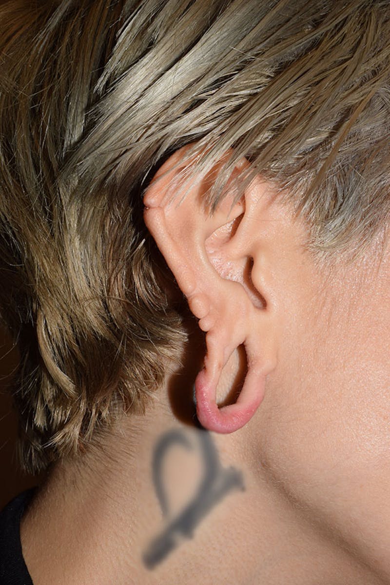 Ear Lobe Repair Before & After Gallery - Patient 542309 - Image 3