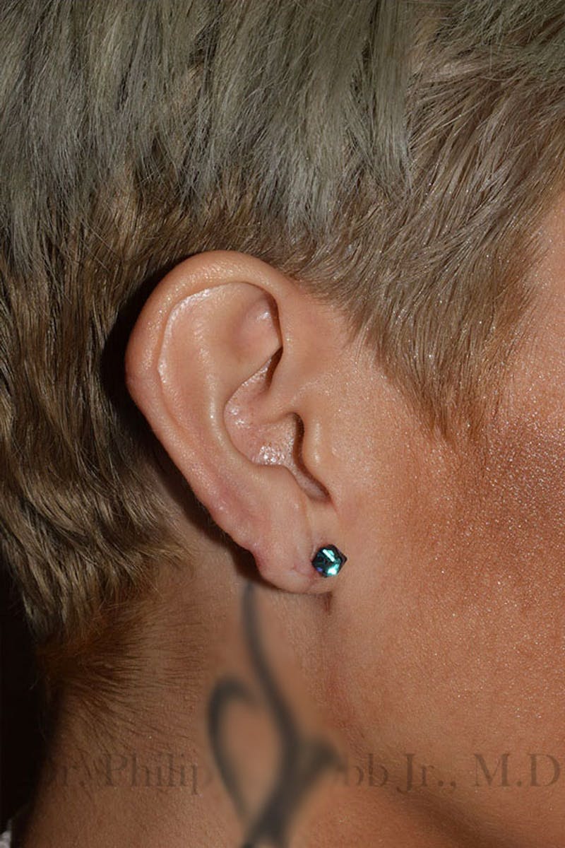 Ear Lobe Repair Before & After Gallery - Patient 542309 - Image 4